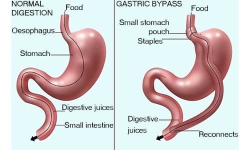 Gastric Bypass