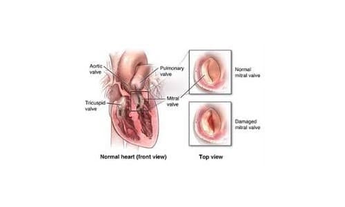 اصلاح واستبدال صمامات القلب