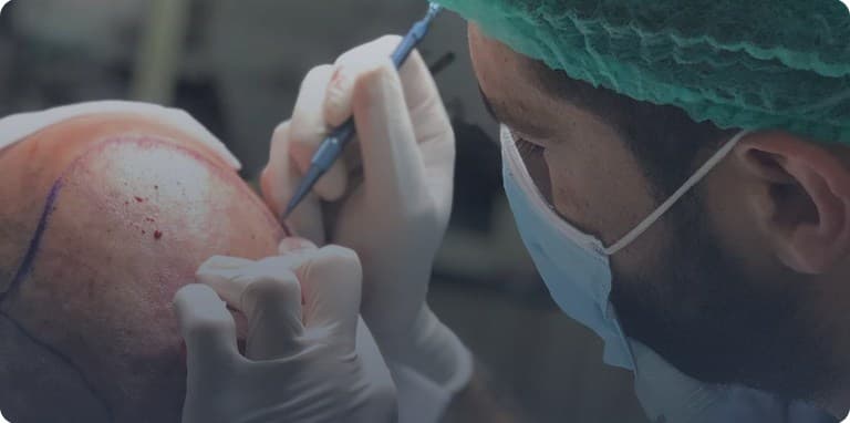 زراعة الشعر (FUE و DHI)