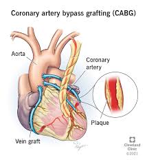 CABG Surgery