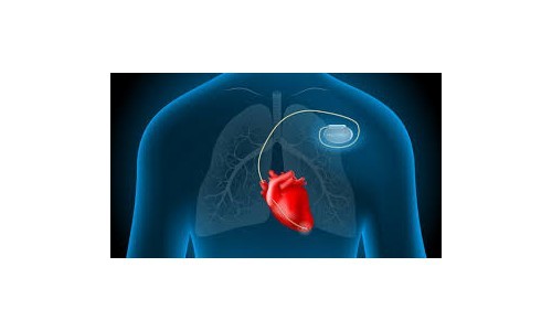 Pacemaker