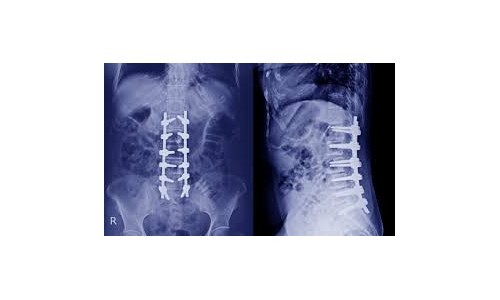 Spinal Surgery